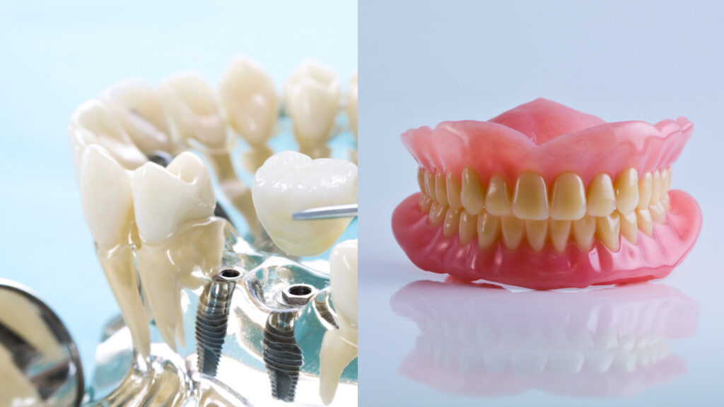 Dental Implants vs Traditional Dentures