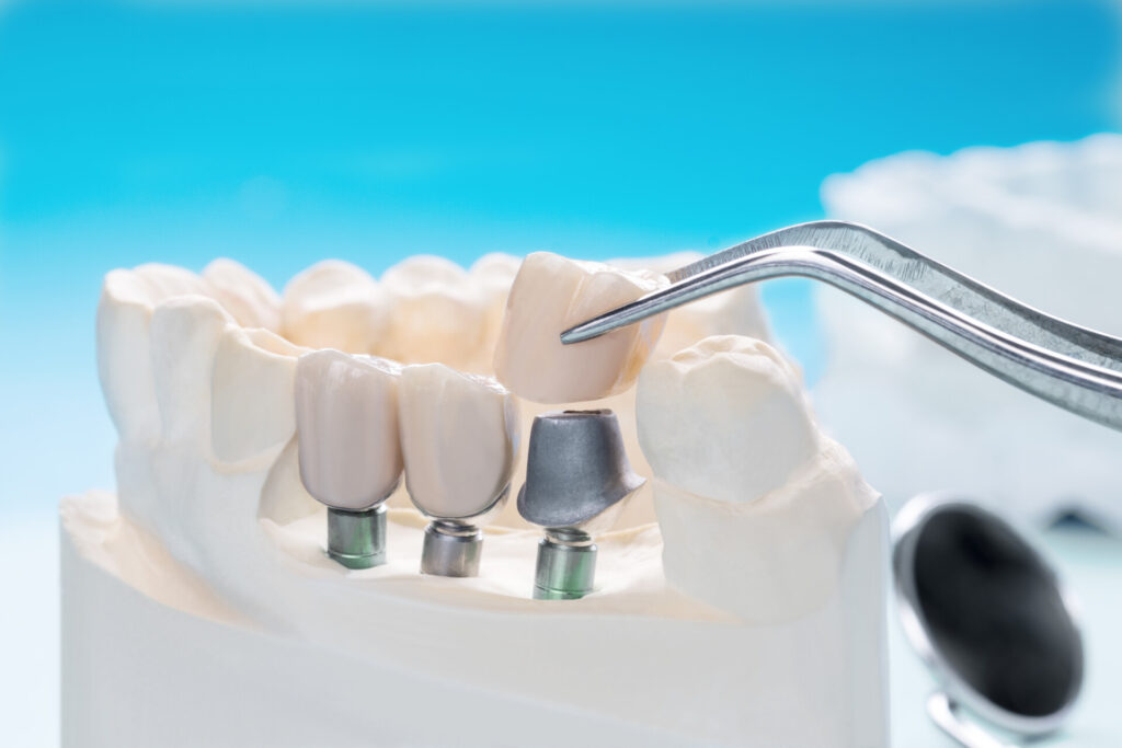 The benefits of dental implants over traditional dentures