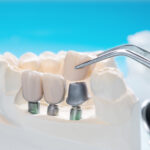 The benefits of dental implants over traditional dentures