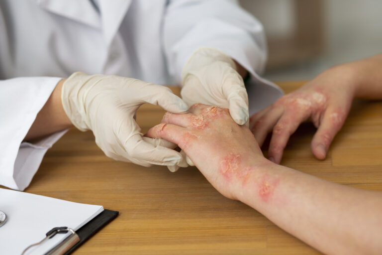 Managing Eczema: Causes, Triggers, and Treatment Options