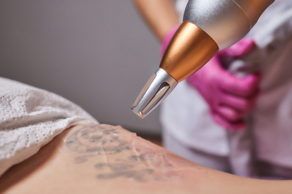 Tattoo Removal: What You Need to Know Before Starting Treatment in the UAE